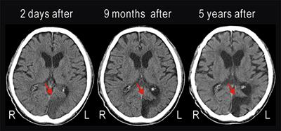 Rapid Recovery From Cortical Blindness Caused by an Old Cerebral Infarction